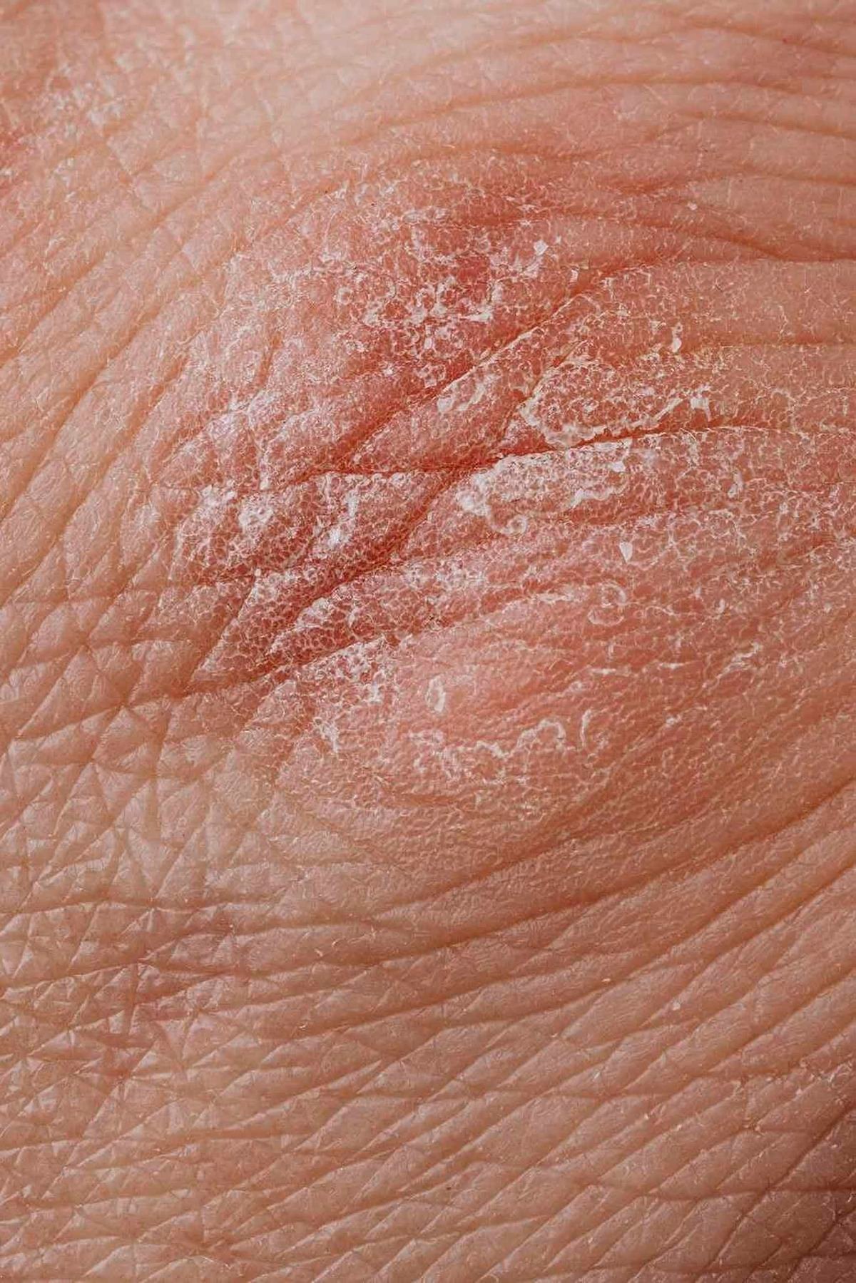 Skin before — dry, flaking barrier